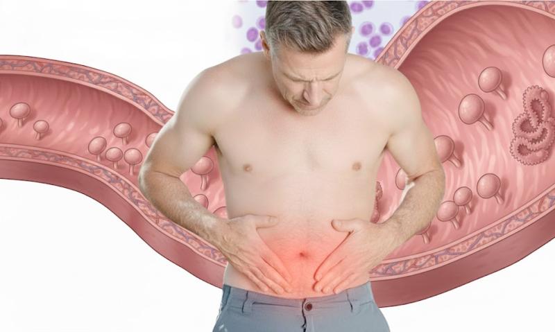 Полипы в кишечнике: чем опасны и как вовремя выявить